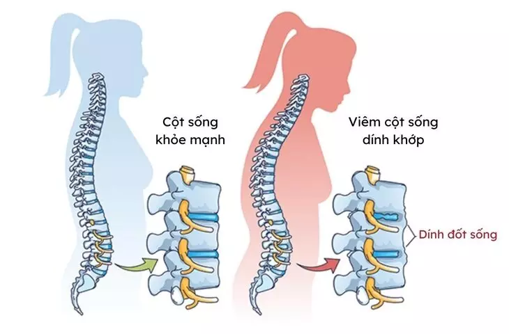 Người bị viêm cột sống dính khớp nên ăn gì? Kiêng gì?  